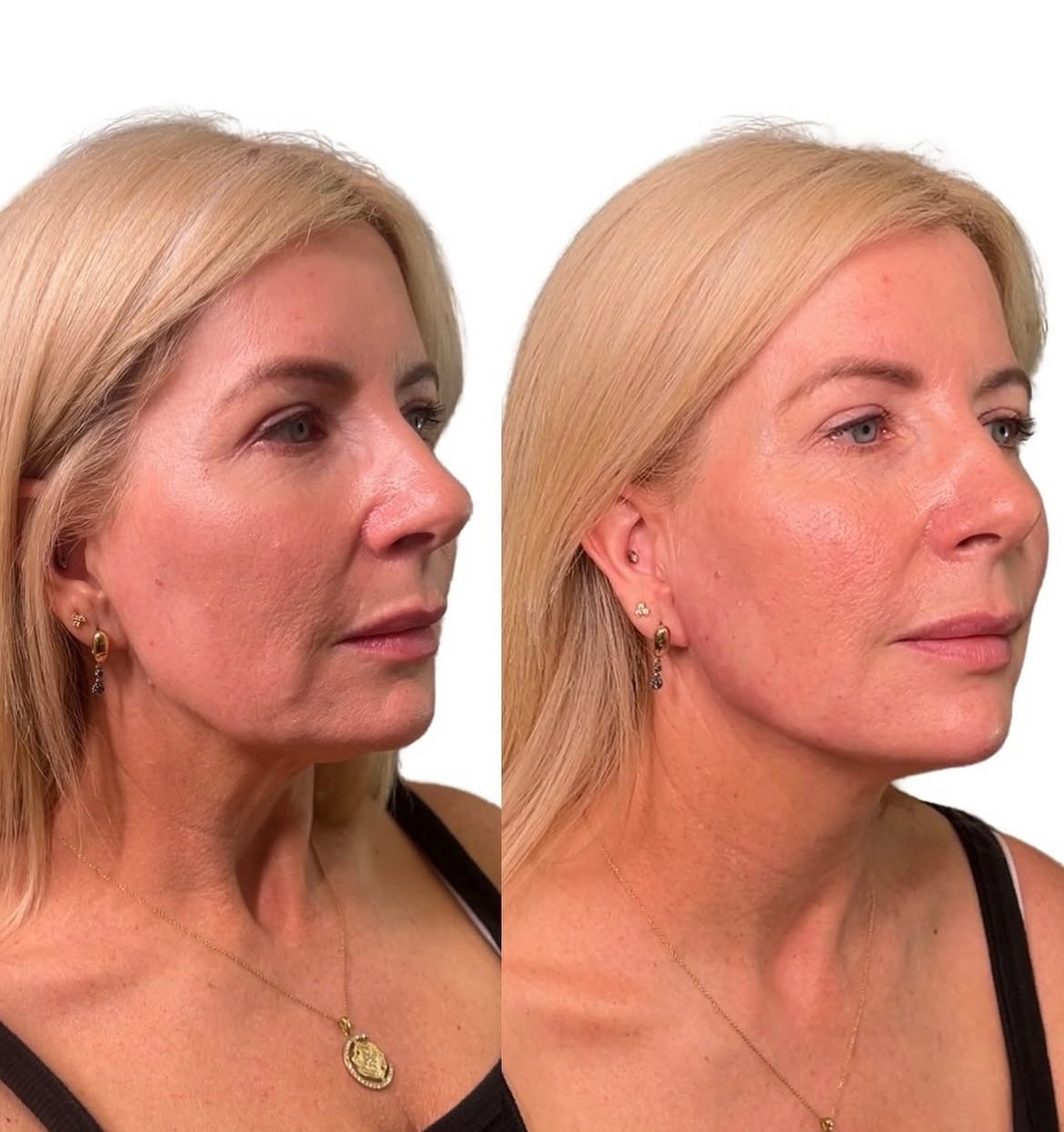 Original side by side client photos for the Contour 4ml Package