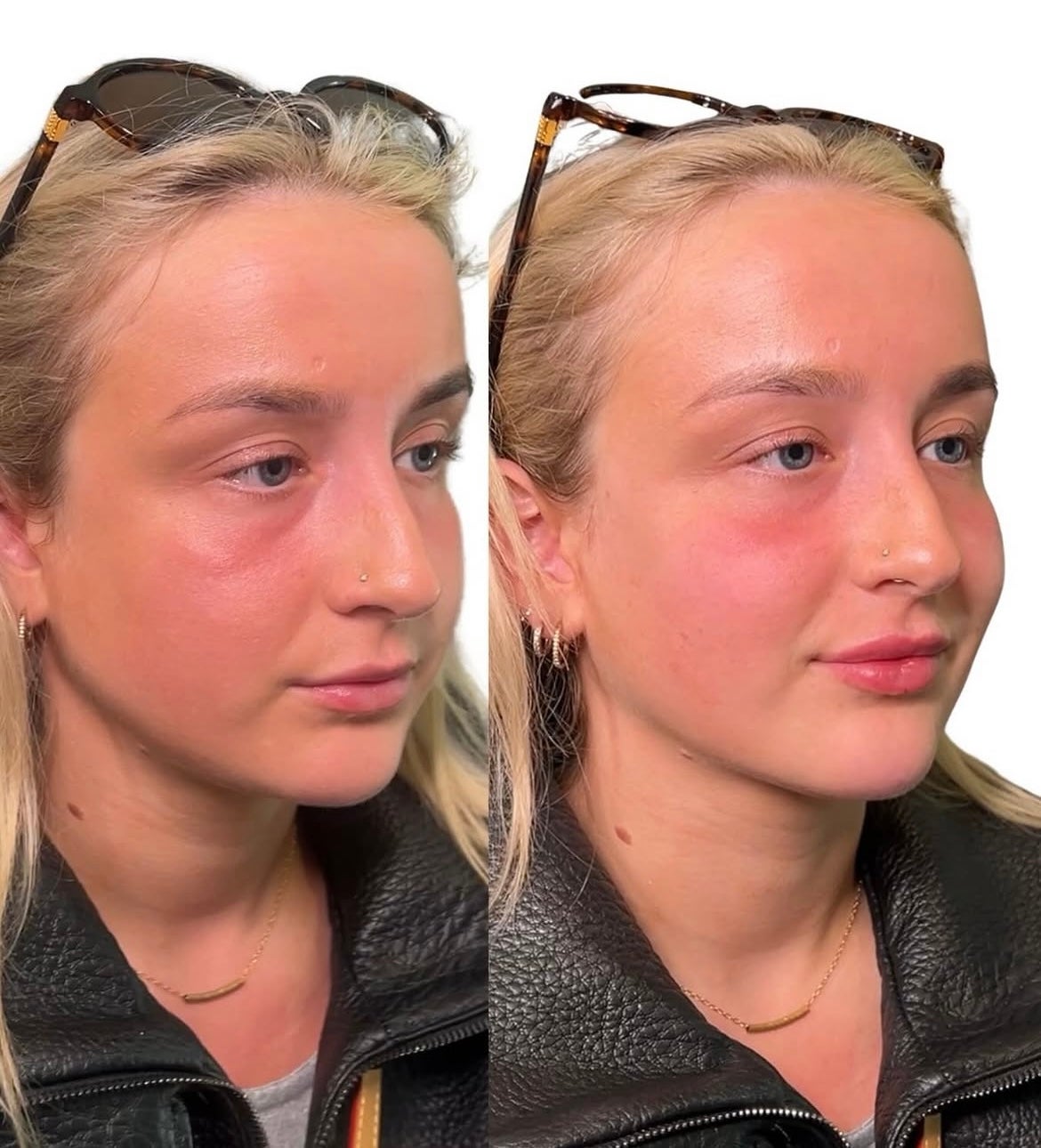 Original side by side client photos for the Enhance 3ml Package