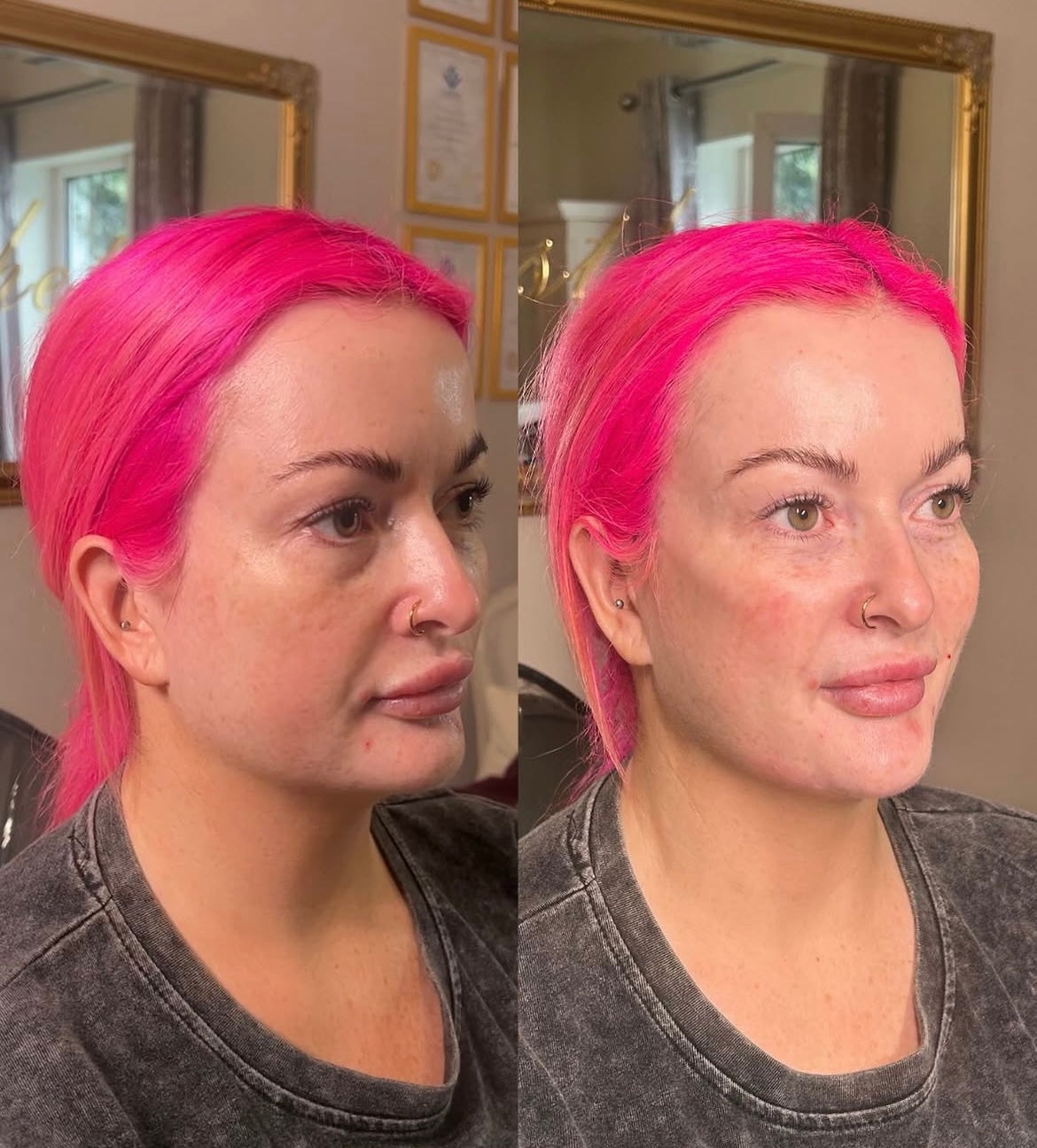 Original side by side client photos for the Revamp Package 6ml